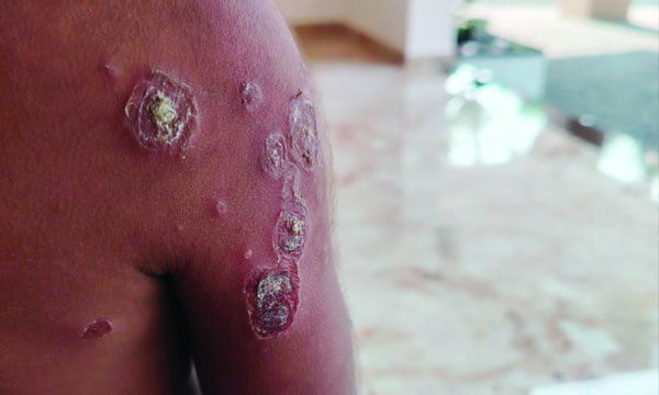 Five people, including three children, suffer sunstroke in the state; victims include an Anganwadi teacher and a sawmill worker