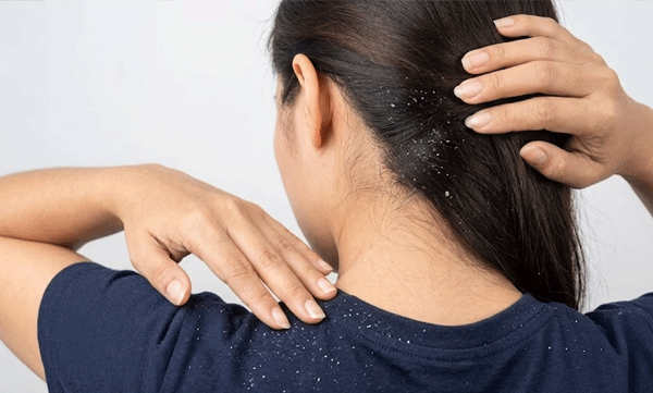 think-dandruff-is-just-dry-scalp-here-s-what-dermatologists-want-you-to-know